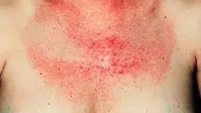 Cancer brulures radiothérapie