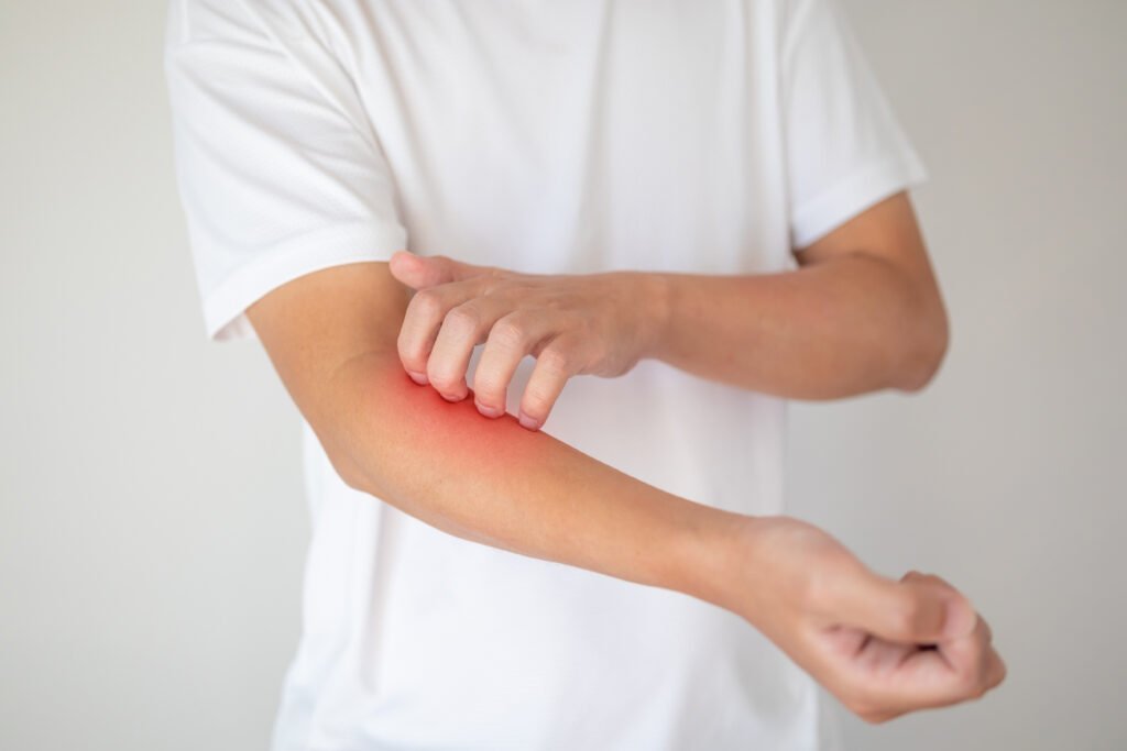 Homme qui se gratte le bras à cause d'une peau sèche et irritée